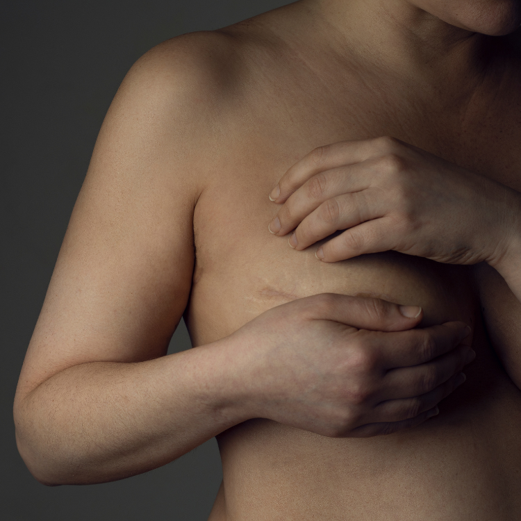 Breast Augmentation Scar Treatment Florida Breast Augmentation Scar Treatment Florida